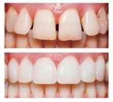 Moderní dýhy na zuby: to, co je