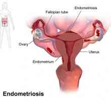 Spirální „Mirena“ Endometrióza: recenze