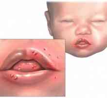 Stomatitida u kojenců: léčba a prevence