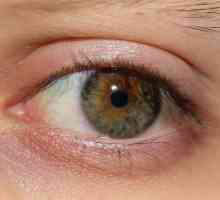 Suché oči: Příčiny a léčba lidových prostředků a kapky