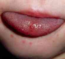 Vyrážka u úst dítěte: Jaké nemoci je příčinou?