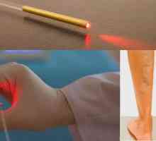 Žíly laserové odstranění: recenze, důsledky a rehabilitace