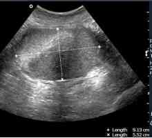 Pánevní ultrazvuk-li o to: před nebo po menstruaci?