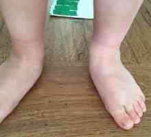 Valgus nohy na miminko: příčiny, léčba. Ortopedické dětská obuv