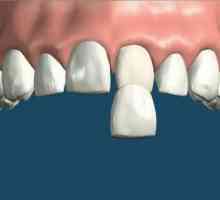 Dýha na zuby výhody prvku rysy jeho instalaci a indikace pro použití