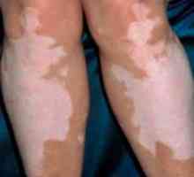 „Vitiks“ (gel a tablety) pro léčbu vitiliga: návod k použití