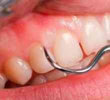 Zánět dásní okolo zubů moudrosti. Jako doma odstranit zánět dásní