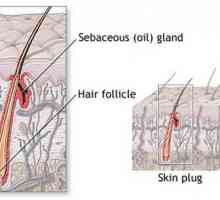 Zánět vlasových folikulů: příčiny, příznaky, léčba. Prevence zánět vlasových folikulů