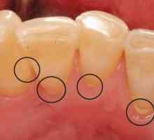 Zdravá ústní dutina: jak odstranit zubní kámen v domácnosti