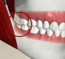 Zub moudrosti: zda se má odstranit „Skupina osmi“, který bolí?