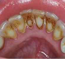 Tartar - Jak se zbavit? Zubní pasta od zubního kamene. Odstranění zubního kamene - recenze
