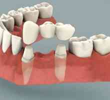 Zubního můstku: recenze. Instalace zubní můstek