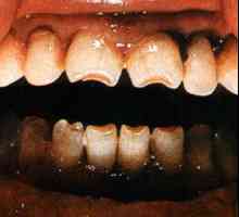 Hutchinson zuby: příčiny, popis tvaru a struktuře, foto