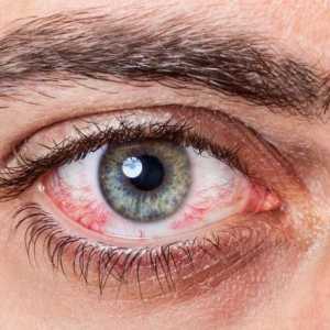 Alergie na oči: jak se chovat, účinné metody a doporučení