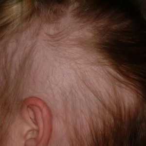Alopecie u dětí: příčiny a léčba. Alopecie, a celková alopecie u dětí