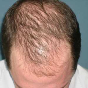 Ampule vypadávání vlasů - Co a jak uplatňovat