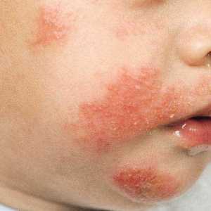 Atopická dermatitida je dítě: příčiny, příznaky, léčba