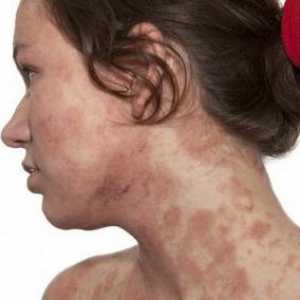Atopie - atopická dermatitida je ...
