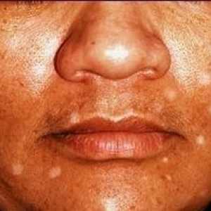 Bílé skvrny na obličeji může být příznakem vitiligo