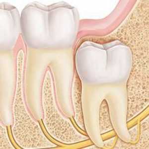 Bolavý zub moudrosti: jak k úlevě od bolesti? Jak zmírnit bolest vybuchnutí zuby moudrosti?