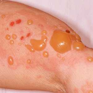Bulózní dermatitida: příčiny, příznaky, diagnostika a léčba
