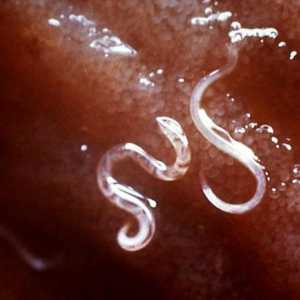 Worms u člověka. Škrkavky jsou paraziti Léčba a prevence