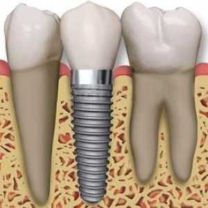 Že zubaři doporučujeme, když je potřeba vložit zuby?