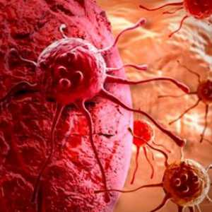 Co je rakovina metastazující? Maligní nádory a metastázy