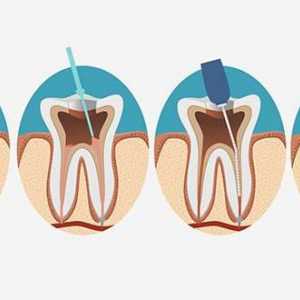Zubní kořenový kanálek: k dispozici procedury, indikace