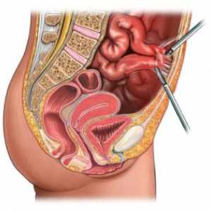 To, co se provádí laparoskopicky vaječníky?