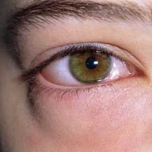 Pokud oteklé oči, příčiny mohou být různé. To platí jak pro dospělé a pro děti