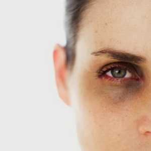 Máte-li tmavé oční víčka, co to znamená a jak s ní bojovat?