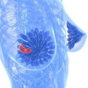 Fibrocystické onemocnění prsů: léčba, příznaky a příčiny