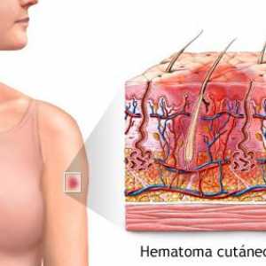 Hematom - hematom ...: typy, příčiny, příznaky