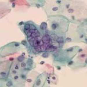 Herpes typ 6 - co tento virus je a jak ji léčit?
