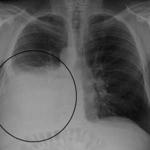 Hydrothorax jednoduché: příčiny, příznaky a léčba