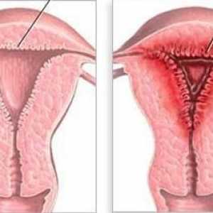 Hyperplazie endometria: co je to? Příčiny, příznaky a léčebné metody