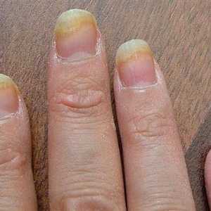 Houba na nehty rukou: popis nemoci a léčby
