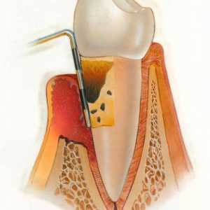 Chronické a akutní parodontitidy: symptomy, příčiny a léčba