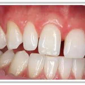 Malocclusion u dospělých. Zdravé zuby - krásné zuby