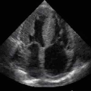 Echokardiografie srdce: rysy tohoto průzkumu a indikace k jeho chování