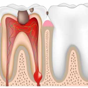 Etapy pulpitis léčby léky. endodontické ošetření