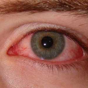 Jak se zbavit syndromu suchého oka?