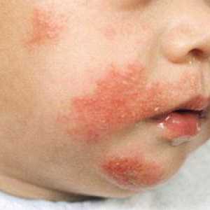 Jaký by měl být lék pro děti od alergií