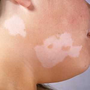 Jaké jsou příznaky a příčiny vitiligo?