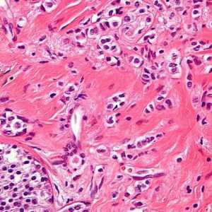 Karcinom - Co je to? karcinom dlaždicových buněk
