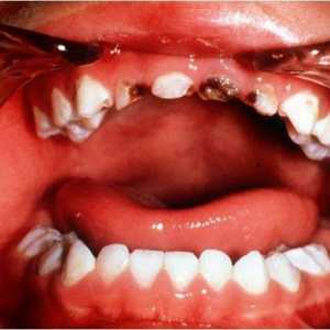 Zubní kaz u dětí. Příčiny, léčba, prevence