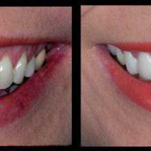 Keramické korunky na přední zuby