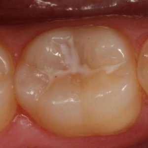 Klasifikace zubního kazu. Typy a klasifikace zubního kazu u dětí