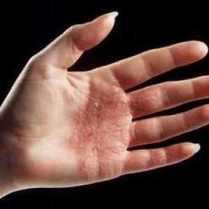 Sinister dermatitidy na rukách: léčba
